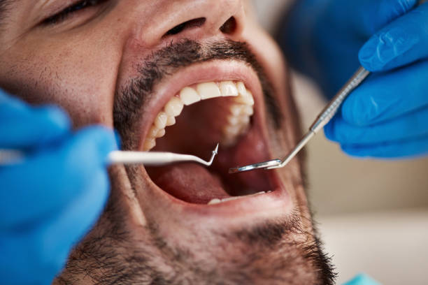 Best Emergency Wisdom Teeth Removal in Flanders, NJ