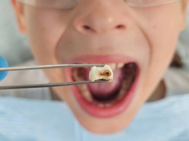 Best Emergency Broken Tooth Repair in Flanders, NJ